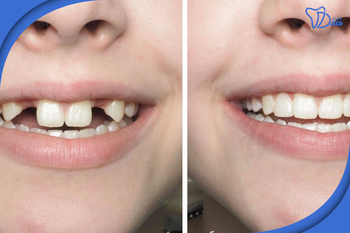 روش های رایج دندانپزشکی زیبایی