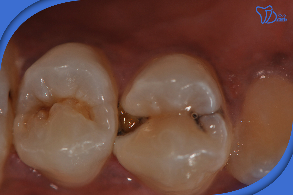 درمان حساسیت بعد از ترمیم دندان در خانه