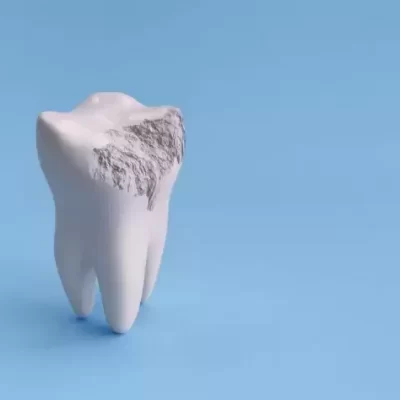 فرسایش مینای دندان