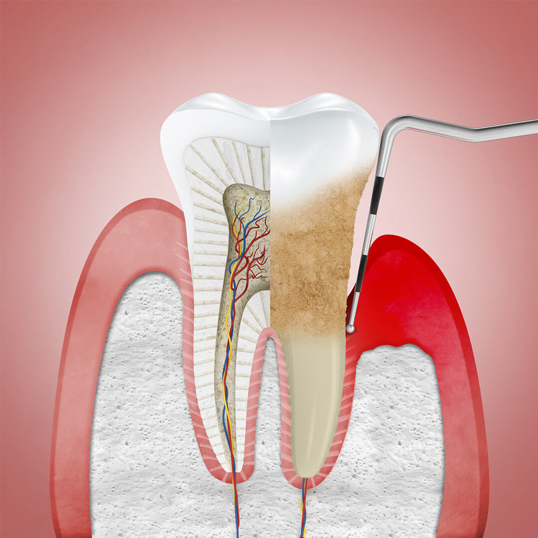 2.3.3 Stages Periodontitis