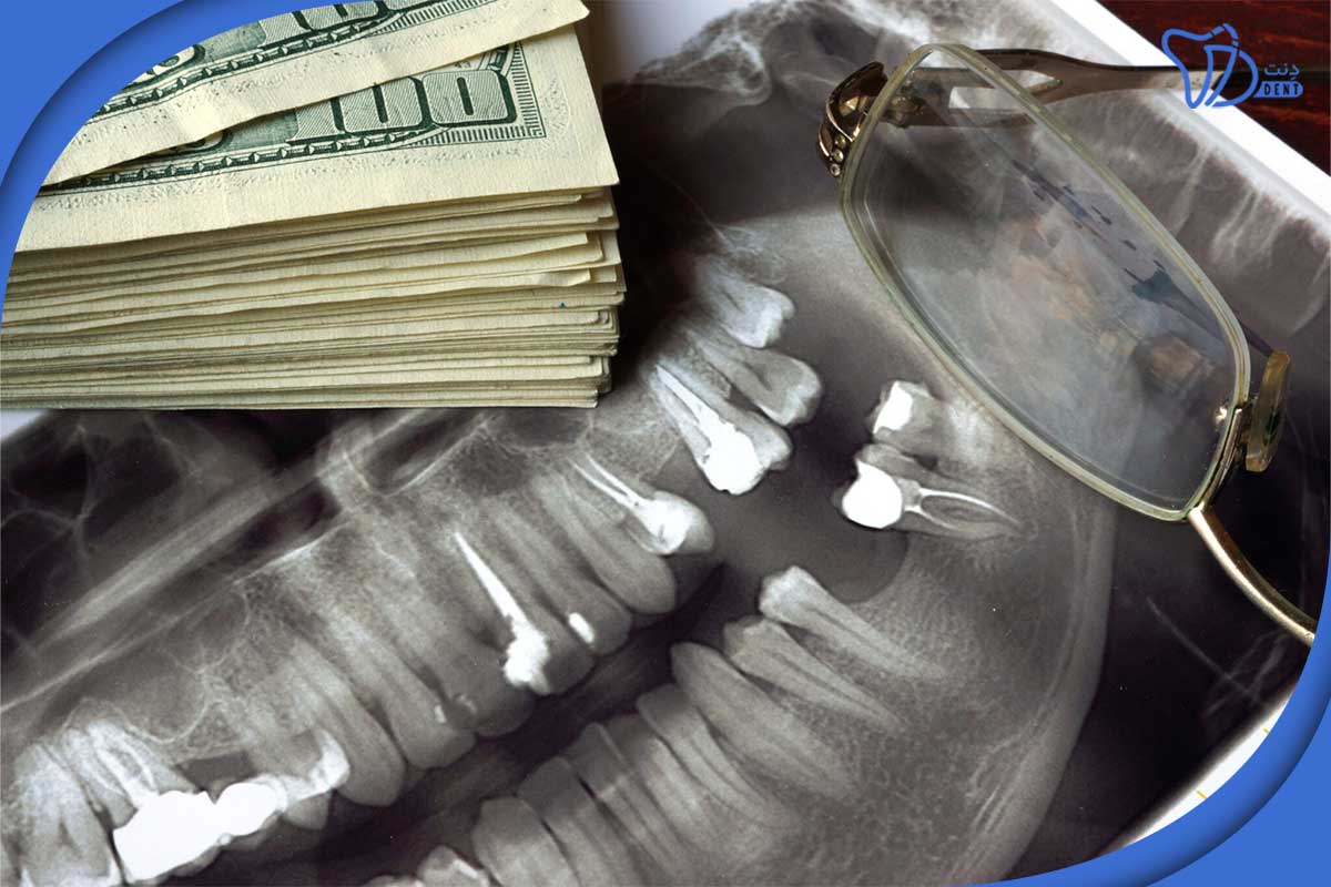 قیمت ایمپلنت دندان ایرانی