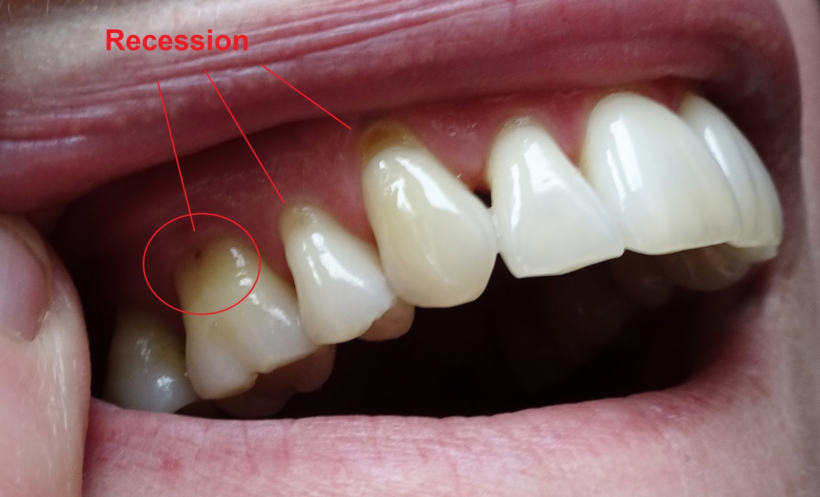 teeth recession