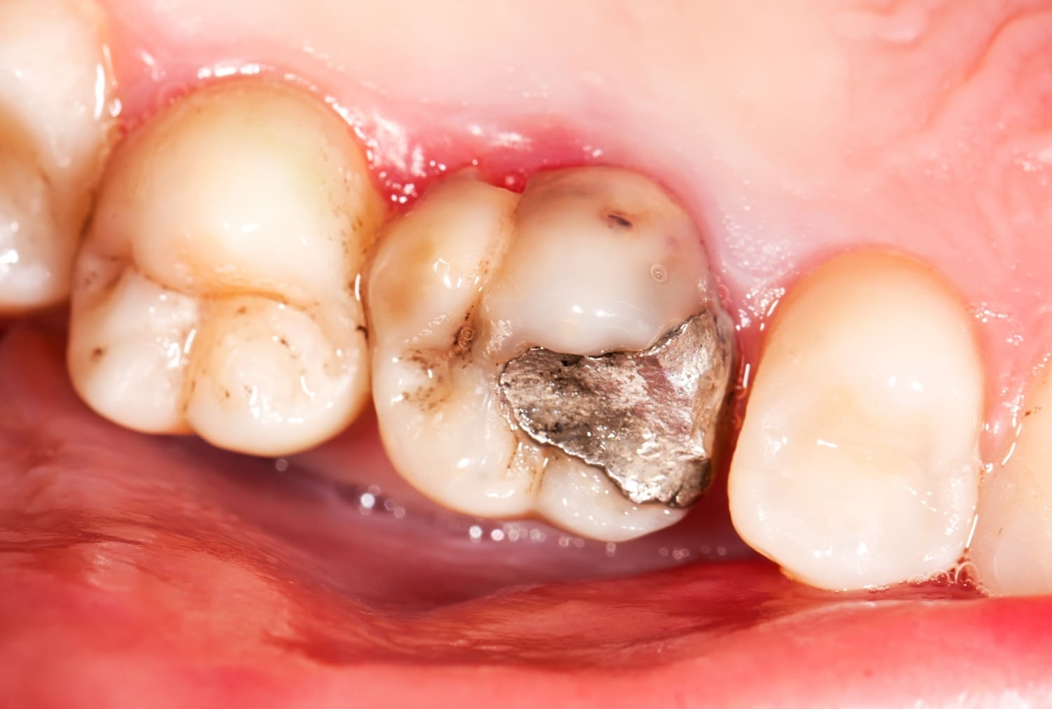 decay under a dental crown patient case study 6092d2dfa558f