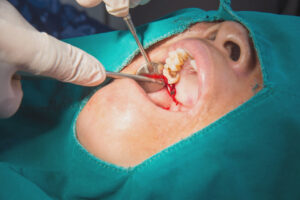 Wisdom Tooth Removal 1