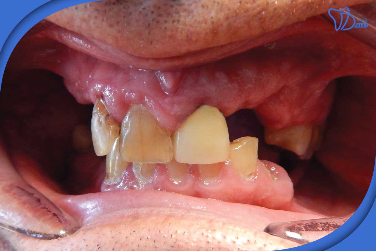 دلایل استفاده از دندان مصنوعی