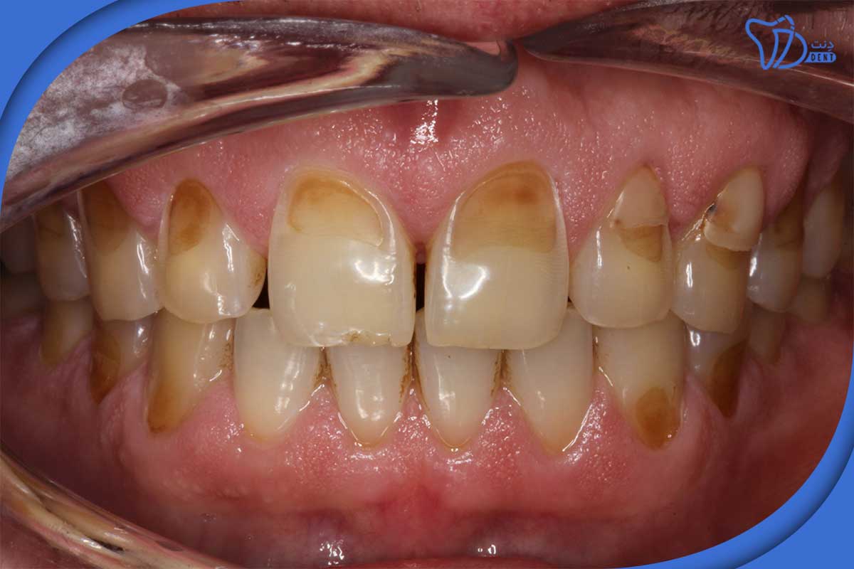 عکس فرسایش دندان ها به دلیل اسید