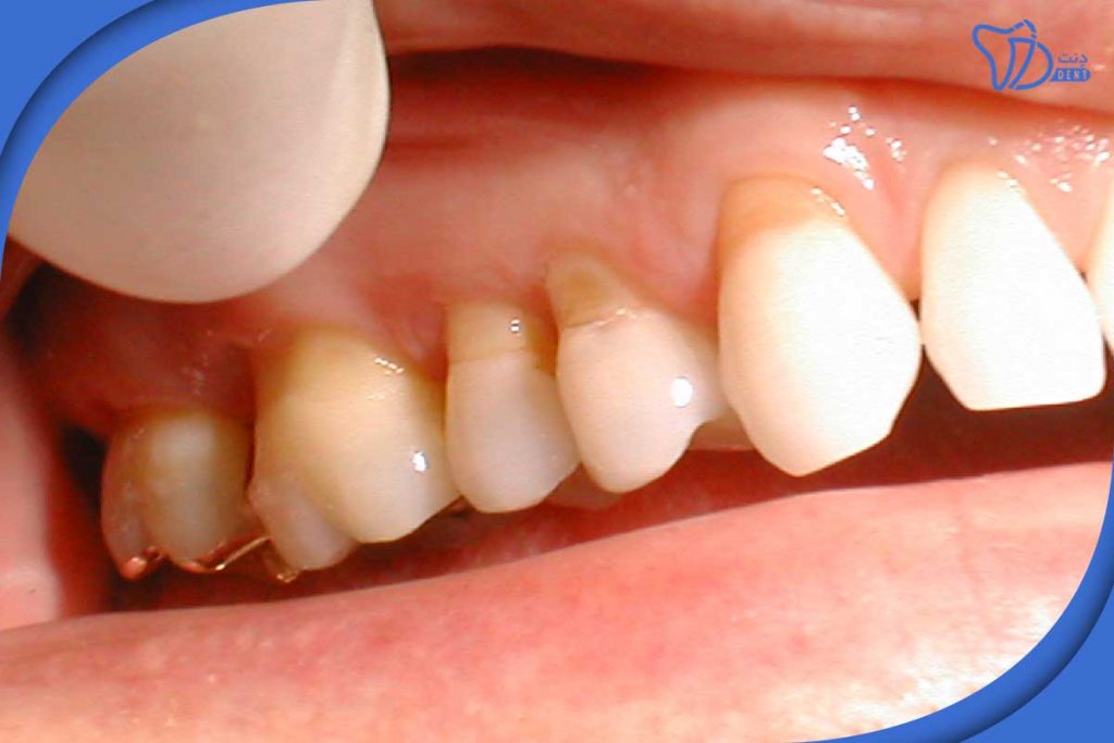 تاثیر اسید بر دندان ها