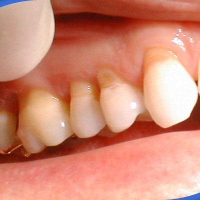 تاثیر اسید بر دندان ها