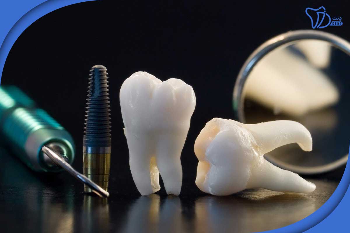 مزایای درمان ایمپلنت دندان چیست؟
