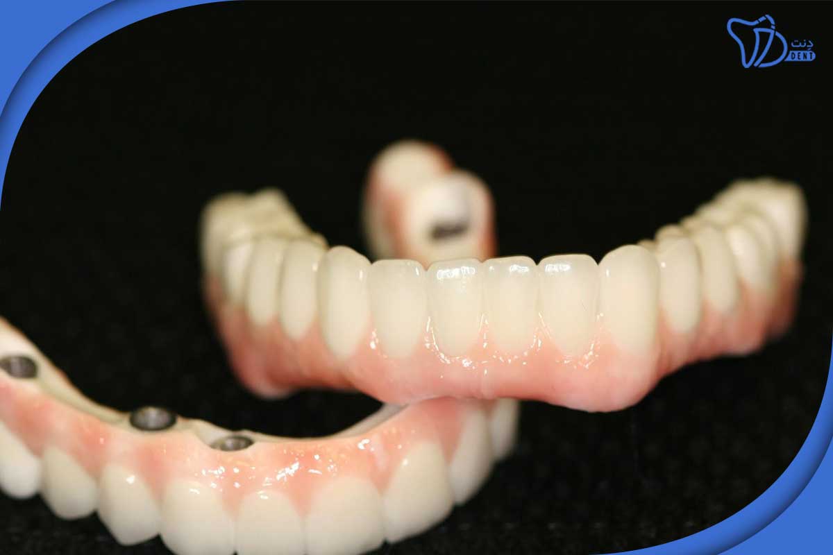 چه چیزی ایمپلنت دندان را به گزینه‌ای بهتر از بریج و پروتز تبدیل می‌کند؟