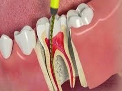 میزان دوام دندان ها بعد از عصب کشی مشخص شد