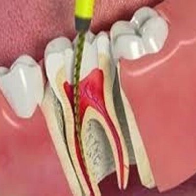 میزان دوام دندان ها بعد از عصب کشی مشخص شد