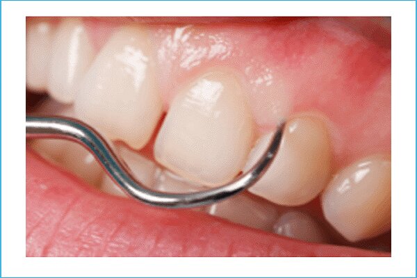 جرم دندان چیست و چگونه تشکیل می‌شود؟