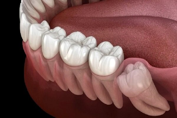 به گزارش خبرگزاری مهر به نقل از یک صندوق پژوهش و فناوری در حوزه سلامت، حمید بهزاد، مدیرعامل یک واحد فناور درباره دستگاه اندوروتاری (اندوموتور) گفت: این دستگاه ابزاری جدید و پیشرفته در ترمیم ریشه دندان است و به منظور آماده‌سازی کانال ریشه دندان از آن استفاده می‌شود. در گذشته به منظور آماده‌سازی کانال ریشه دندان از فایل‌های دستی یا دستگاه‌های غیر اتوماتیک استفاده می‌شد که عدم کنترل دندانپزشک بر حرکات دستگاه، احتمال شکستگی فایل داخل دندان را به همراه داشت اما با کمک این دستگاه می‌توان ریشه دندان را بدون هیچ نقصی تخلیه کرد. مدیرعامل شرکت ادامه داد: این دستگاه مورد استفاده تقریباً تمامی متخصصین درمان ریشه و حدود نیمی از دندان‌پزشکان عمومی است. وی در ارتباط با میزان برابری این محصول با سایر محصولات مشابه بازار گفت: این محصول مطابق با نمونه‌های خارجی ساخته شده است و نمونه داخلی ندارد. بهزاد گفت: واردات این دستگاه موجب خروج سالانه حدود نیم میلیون دلار ارز از کشور می‌شود که با تولید و توزیع این محصول در بازار می‌توانیم ضمن ایجاد اشتغال پایدار، از خروج این مقدار ارز نیز جلوگیری کنیم. وی گفت: ما با حمایت صندوق پژوهش و فناوری حوزه سلامت توانست از تسهیلات نمونه‌سازی صندوق برای تکمیل محصول استفاده کند. این تسهیلات پس از عقد قرارداد با صندوق، در کمتر از یک روز کاری به حساب شرکت واریز شد. حمیدرضا فرهادی، مدیرعامل صندوق پژوهش و فناوری گفت: محصول این شرکت در حوزه دندانپزشکی و تحت عنوان اندوروتاری است؛ این محصول رقیب داخلی ندارد اما حدود ۲۴ شرکت خارجی از ۹ کشور تاکنون محصولات خود را در این بخش به بازار ایران عرضه کرده‌اند. فرهادی ادامه داد: پاکسازی کانال ریشه دندان با بالاترین کیفیت و کمترین زمان، کاهش چشم‌گیر احتمال بروز درد پس از درمان و همچنین سرعت در انجام درمان و کاربری ساده و آسان از مهم‌ترین مزایای این دستگاه است.