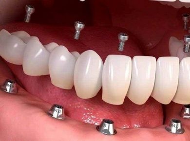 ایمپلنت دندان شبیه به دندان