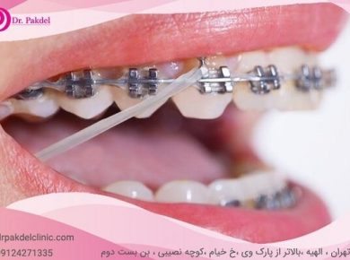 ارتودنسی دندان چیست؟ انواع ارتودنسی دندان