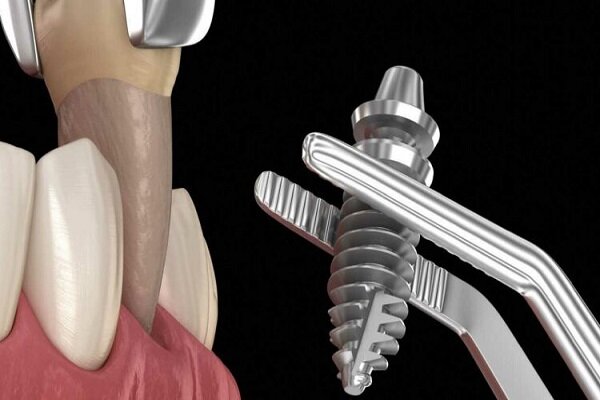 ایمپلنت‌های دندانی