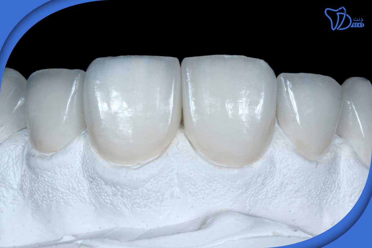 آیا روکش‌های دندانی می‌توانند جایگزین دندان‌های از دست رفته شوند؟