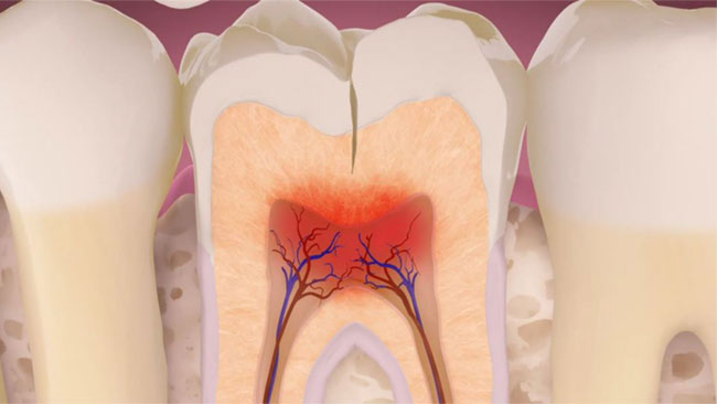 تفاوت دیدگاه دندان‌پزشکان عمومی و متخصص در درمان دندان‌های ترک خورده