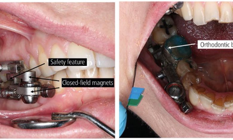 استفاده از ابزار در دهان برای کاهش وزن: نتایج بالینی اولیه