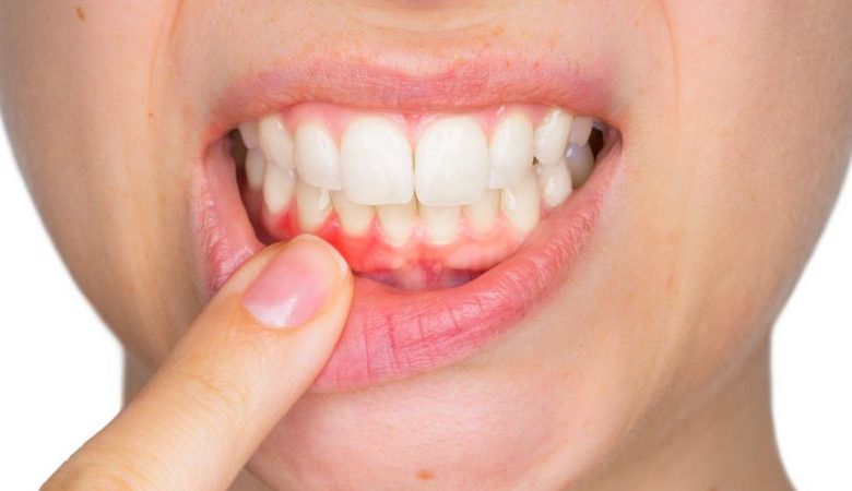 بهداشت ضعیف دهان و دندان