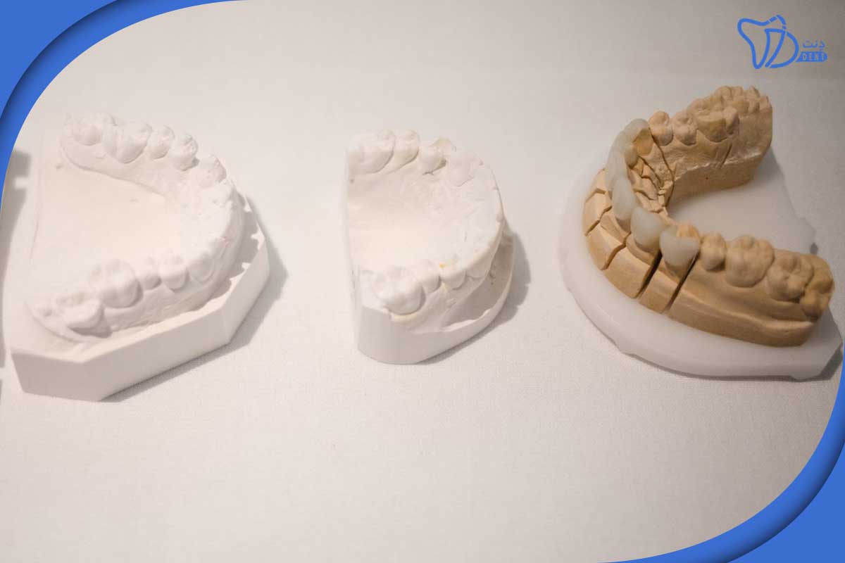 لمینت دندان در تجریش در چه مواردی استفاده می‌شود؟