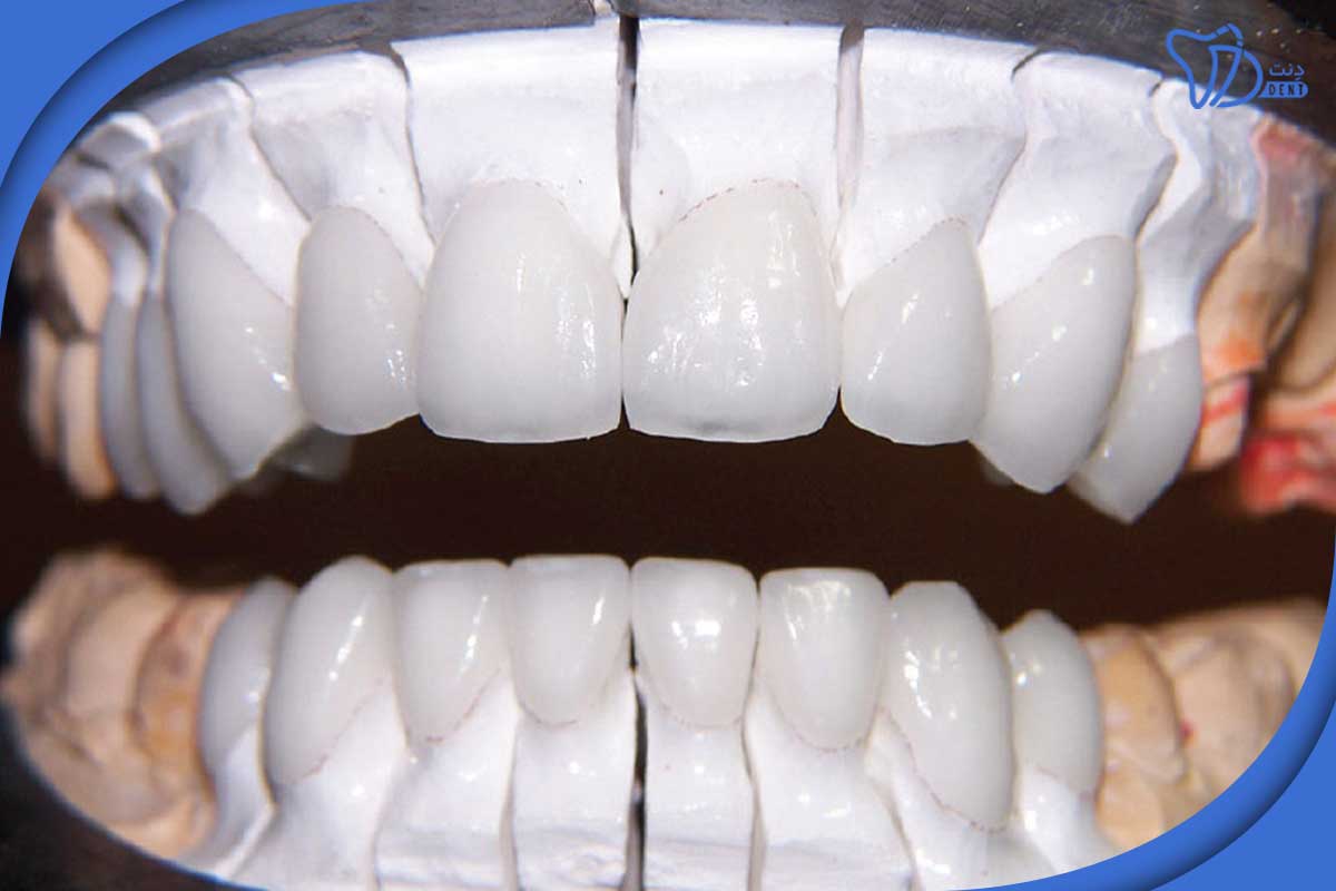 ماندگاری لمینت دندان در تجریش چقدر است؟
