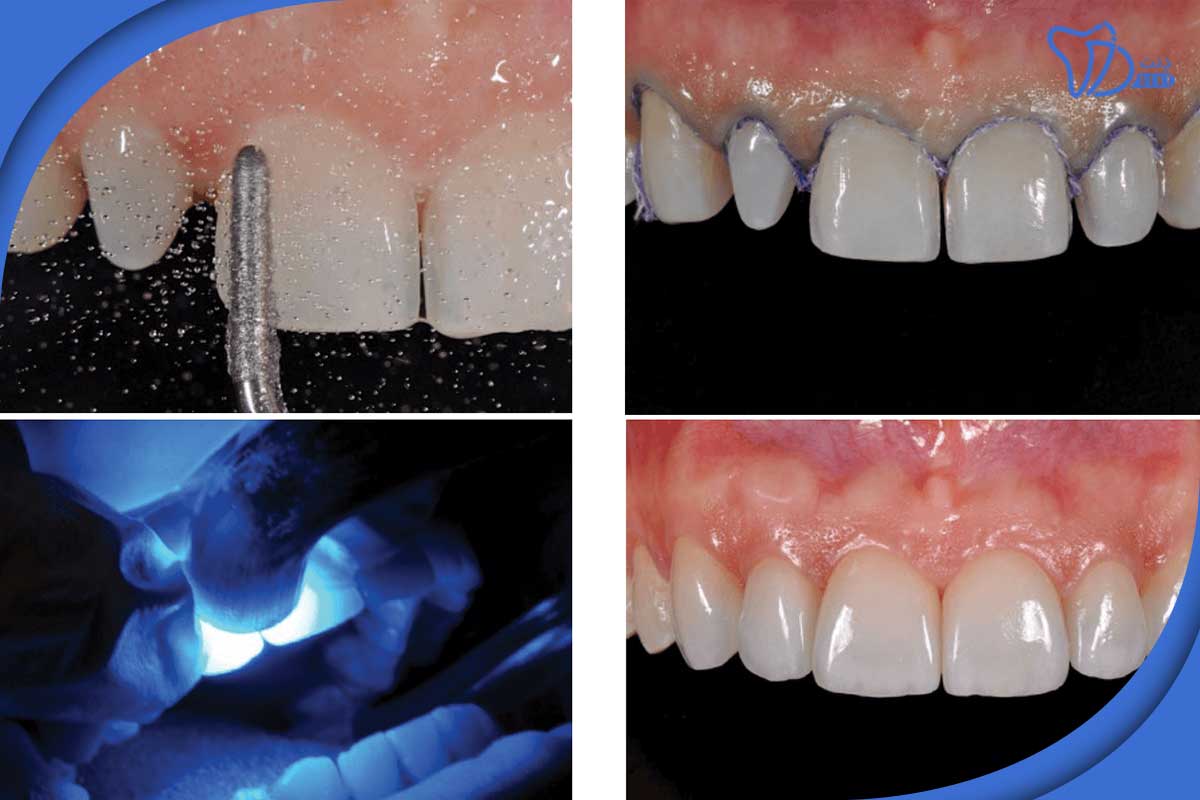 مراحل لمینت دندان در تجریش: