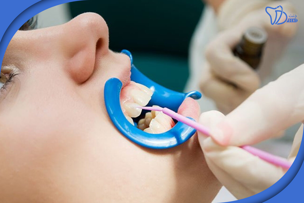 درمان دندانپزشکی برای حساسیت دندان