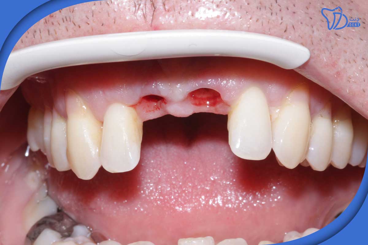 چرا ایمپلنت دندان را انتخاب کنیم؟