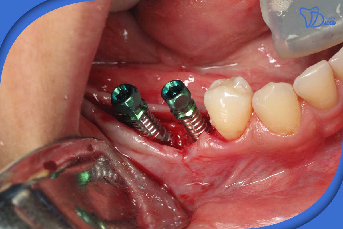 ایمپلنت دندان در جنت آباد: آنچه ما را متمایز می کند
