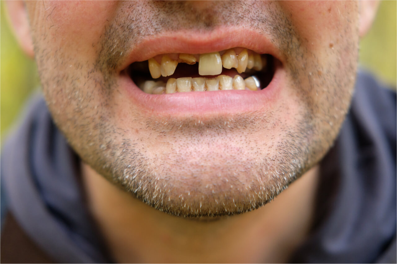 آیا کاشت دندان جراحی است؟