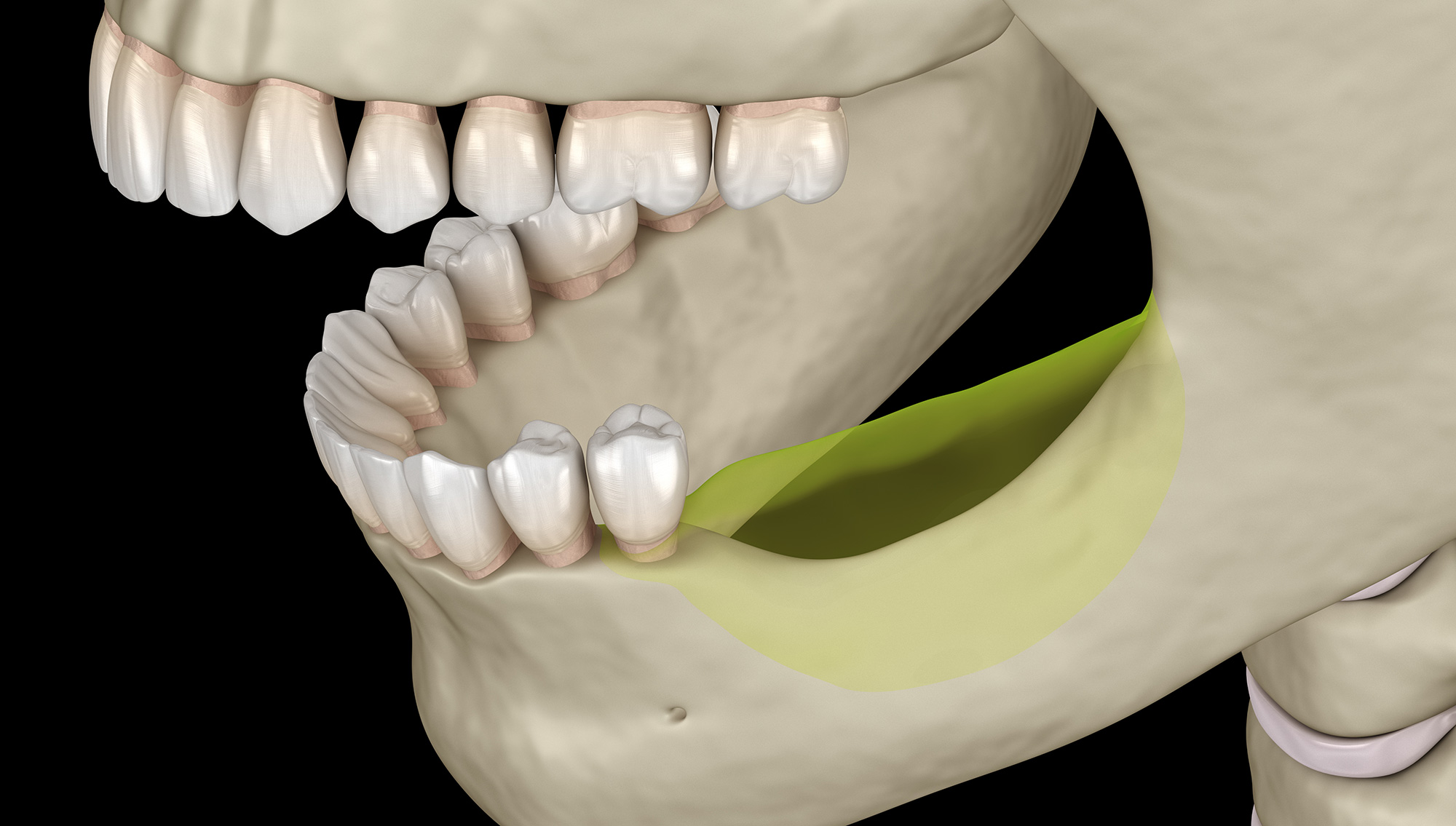 چه ایمپلنت هایی در فک بدون دندان استفاده می شود؟
