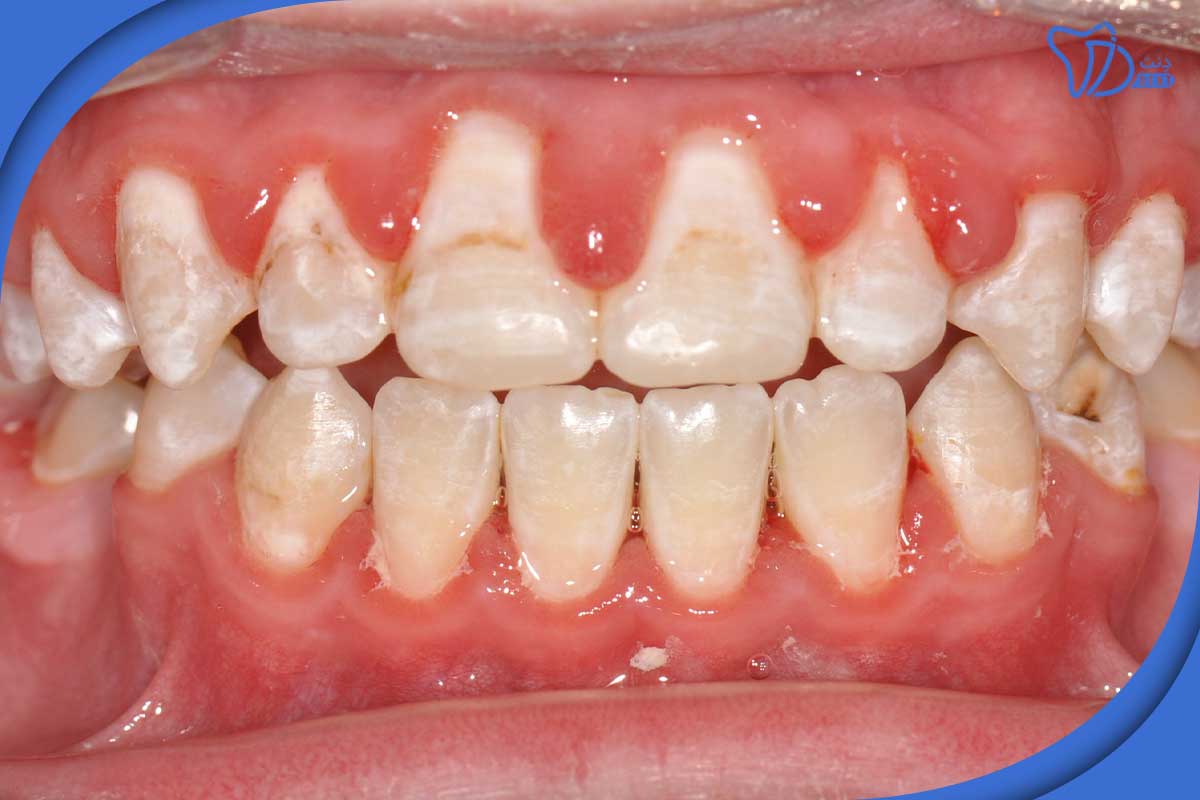 سایر عوامل مؤثر در پوسیدگی دندان