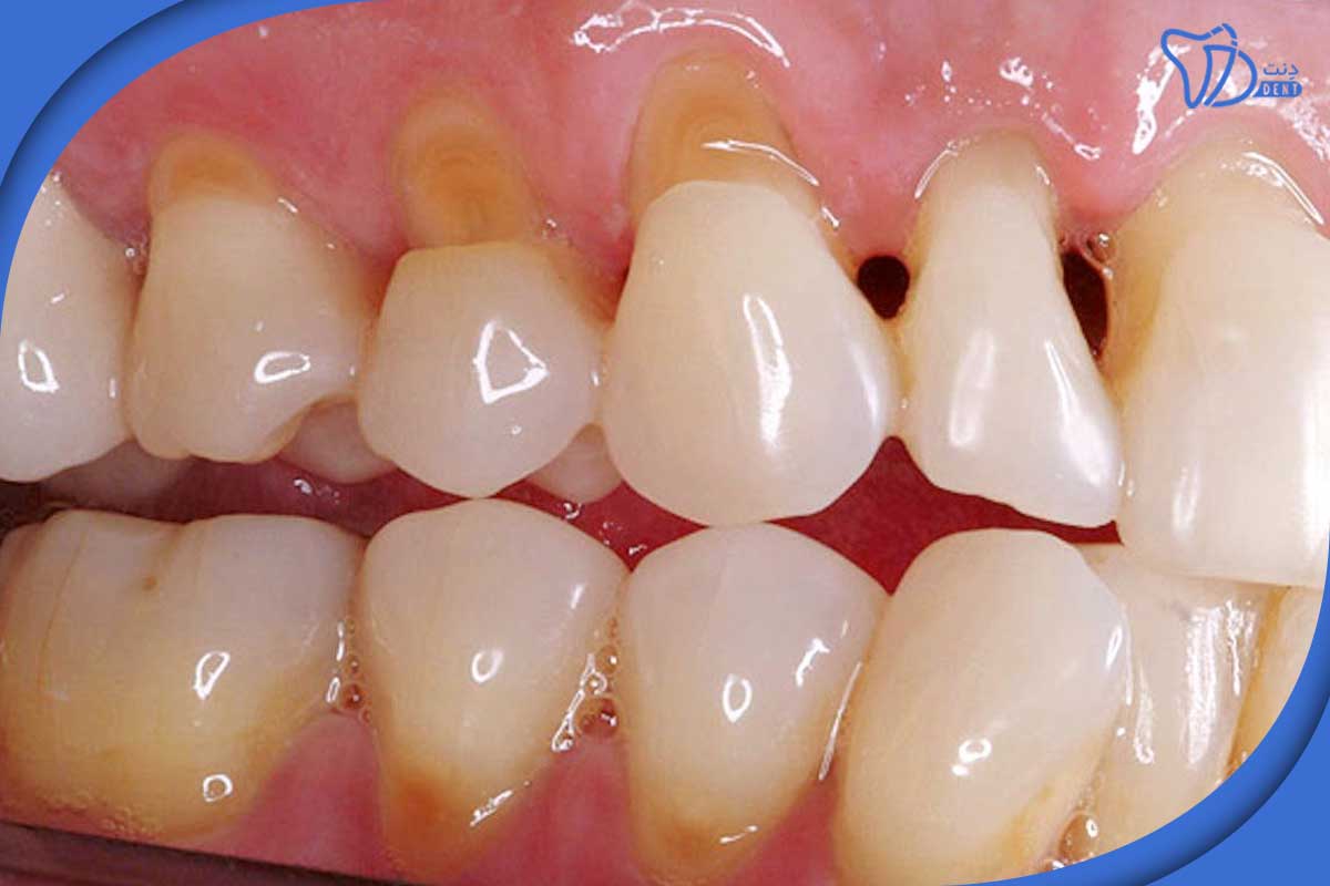 پوسیدگی دندان بعد از مسواک زدن