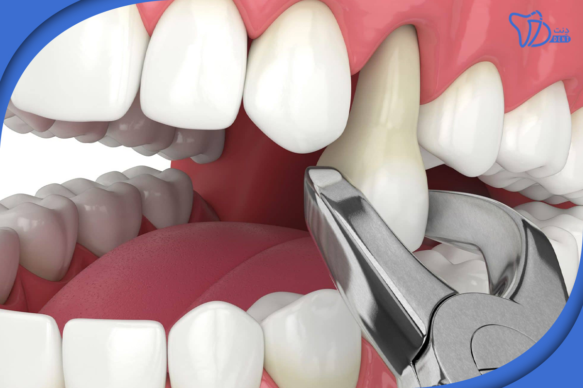 قیمت کشیدن دندان با بیمه تکمیلی چقدر است؟