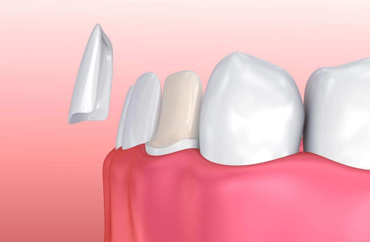 مزایای لمینت دندان در زعفرانیه
