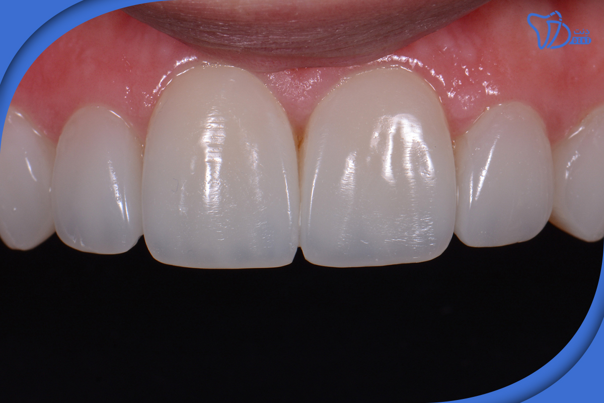 دریافت مشاوره آنلاین از دندانپزشک کامپوزیت دندان خوب در شهریار
