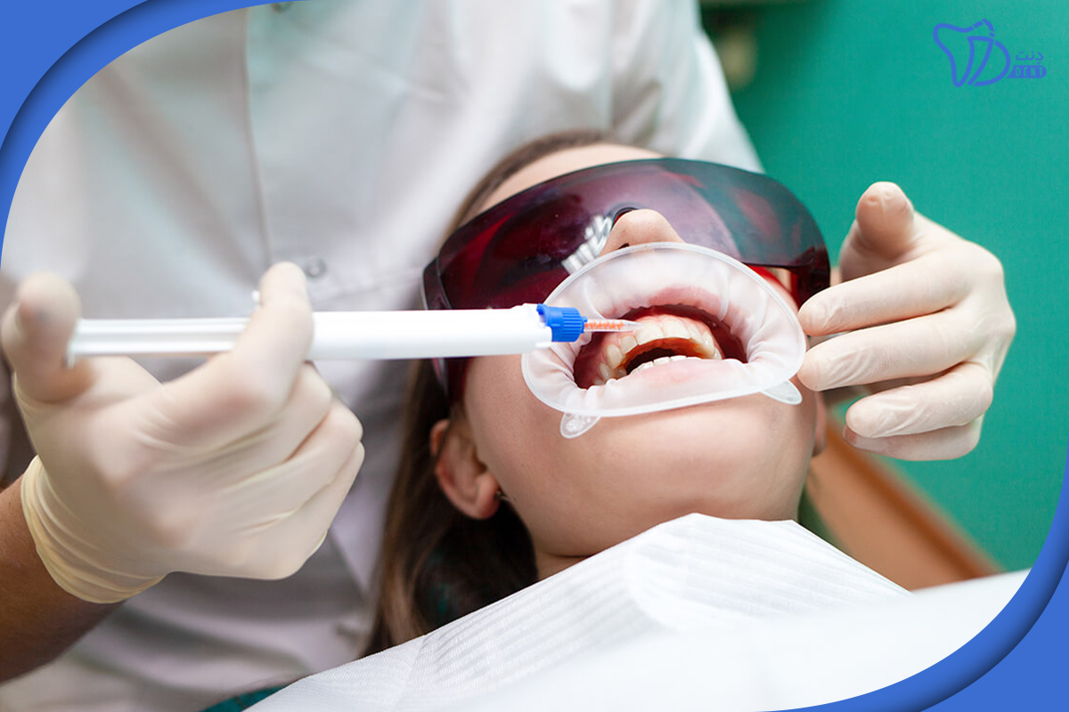 خطرات و عوارض جانبی بلیچینگ دندان