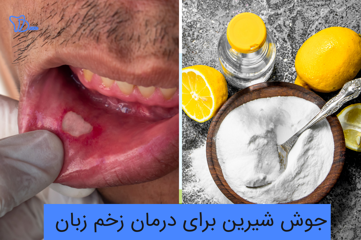 استفاده از جوش شیرین برای درمان زخم زبان: