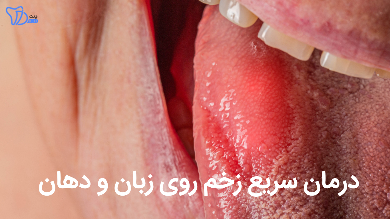درمان سریع زخم روی زبان و دهان