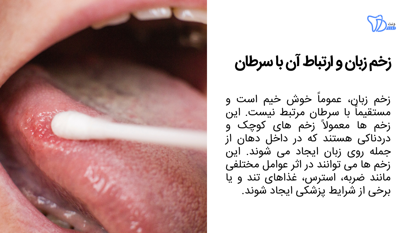 زخم زبان و ارتباط آن با سرطان