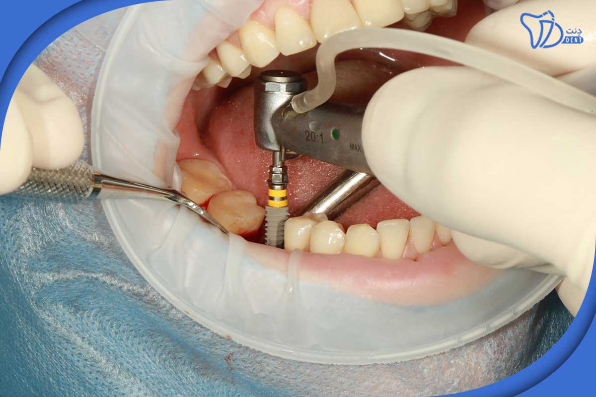 کاشت ایمپلنت دندان در جردن