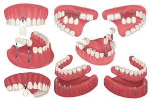 types of dental implants 2